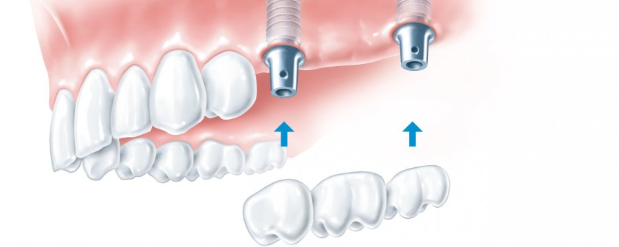 schonende Implantologie | Implantatbrücke