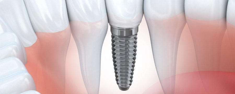 schonende Implantologie | Feste Zähne